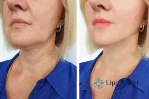 Double chin before and after Hi-Fu treatment 4 Book your double chin treatment Oxford today! We are here to help!