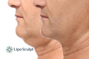 Double chin before and after Hi-Fu treatment 2 Double chin treatment Oxford from Lipo Sculpt - feel more confident today!