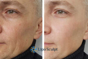 How to Fight Aging Symptoms 3 Fight Aging Symptoms Oxford With HIFU and Morpheus8 Today!
