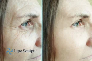 How to Fight Aging Symptoms 2 Do you want to Fight Aging Symptoms Oxford? Contact Lipo Sculpt today!