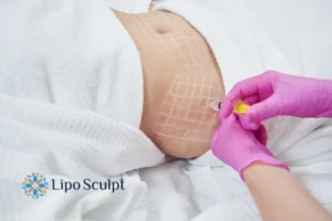 Are The Results From Aqualyx Permanent? 1 Do you want to know how long Aqualyx Oxford results last?