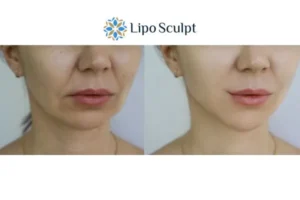 Explaining Total Skin Tightening Treatment And What It Can Do For You 2 Do you want to boost your self confidence? Give Morpheus8 Oxford a try today!