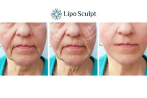 Explaining Total Skin Tightening Treatment And What It Can Do For You 3 Boost your confidence with Morpheus8 Oxford call our team today!