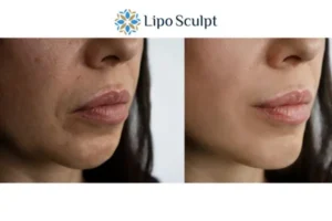 Explaining Total Skin Tightening Treatment And What It Can Do For You 4 Morpheus8 Oxford the best results - call our team today!