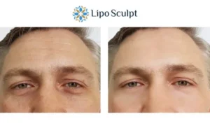 Explaining Total Skin Tightening Treatment And What It Can Do For You 6 Morpheus8 Oxford book in today to find out more!