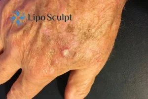 Best Actinic Keratoses Removal 2 Improve your wellbeing and health with Actinic Keratoses Oxford removal.treatment