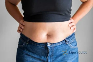 Bidding Farewell to Muffin Tops with Aqualyx Fat Injections 2 Do you wish you could reduce your muffin top Oxford With Aqualy fat dissolving injections you can!